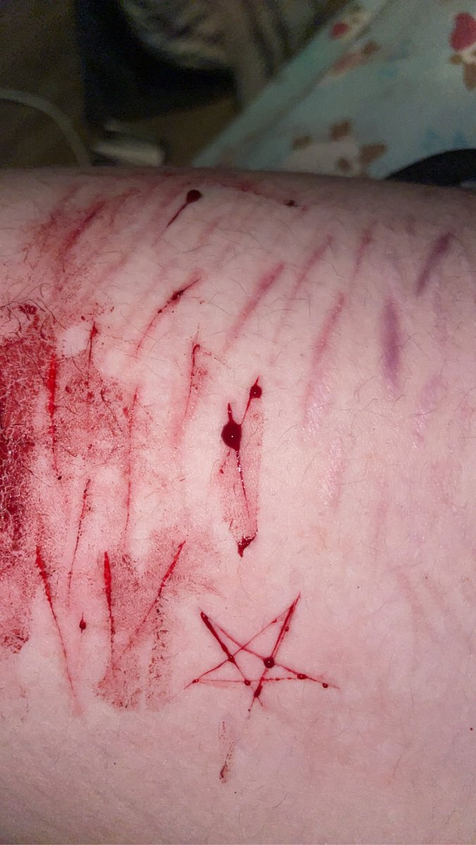 Jakey7189189052's tweet photo. #TwSelfHarm #Cutting
.
.
Made a star
.
. https://t.co/0A55Ec4JZa