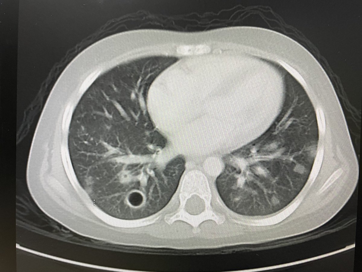 veerendra_patil's tweet photo. This is a CT scan chest pic of a patient with relapse #leukemia on salvage chemo
What are your differential diagnosis ?
#childhoodcancer 
#MedTwitter #PHOdoc https://t.co/LggZ6GH2KZ