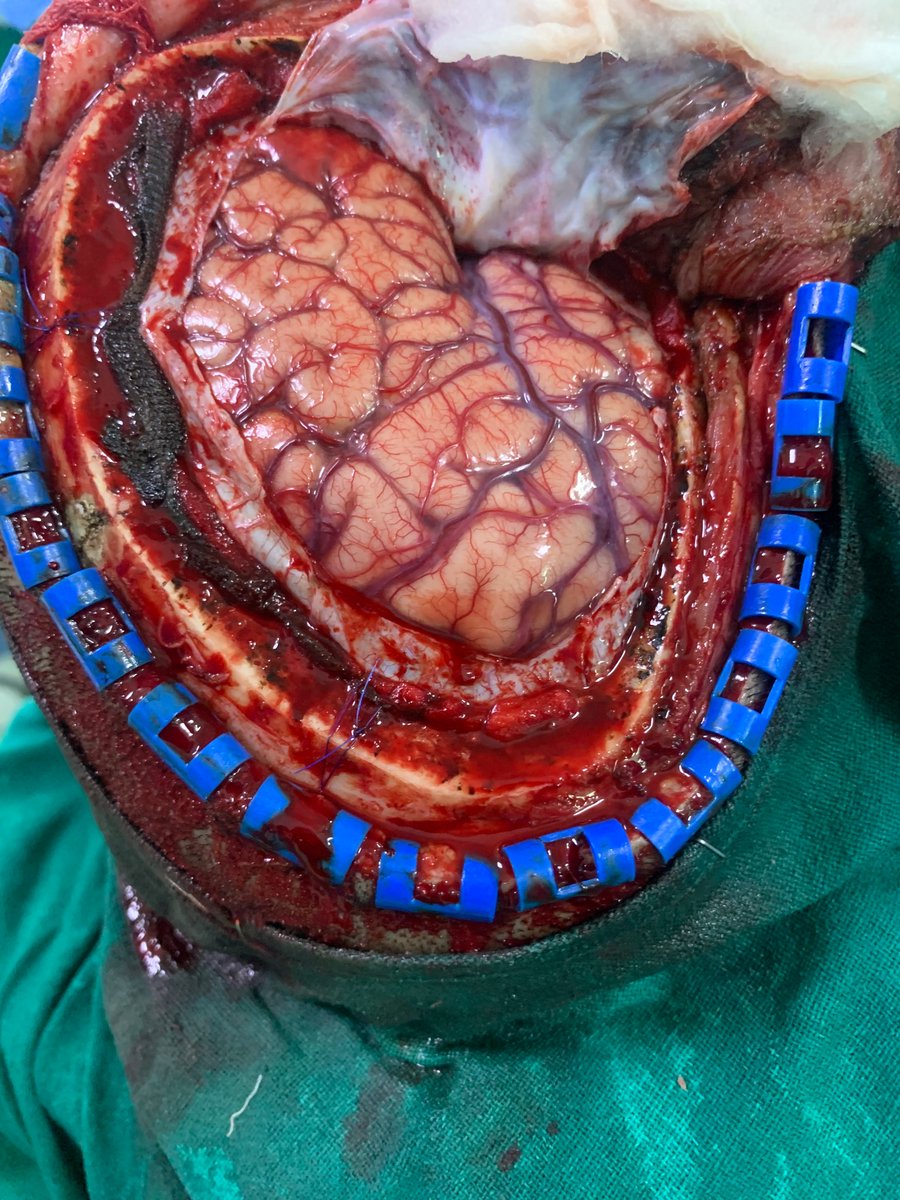 Beautiful Brain 🧠 
The Engine of the Body 
#brain #Neurosurgery #neuroscience #neurotwitter #Neurology 
@OGdukeneurosurg @LizardoGramcko