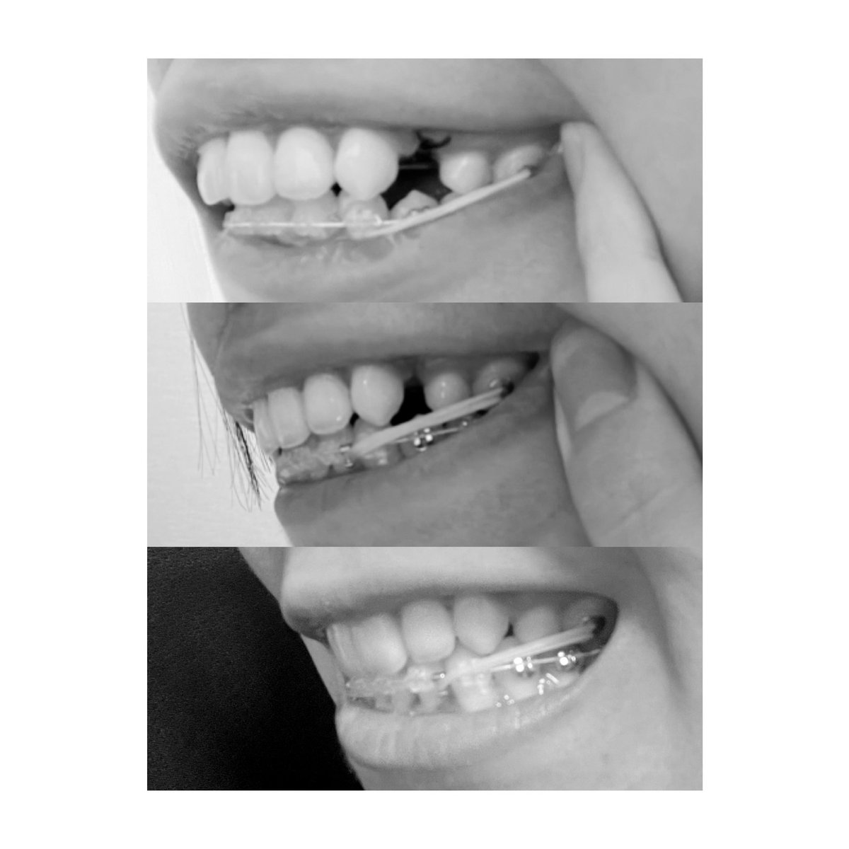 ak_ortho's tweet photo. 2022/12/22（抜歯直後）
2023/2/12
2023/5/22
抜歯から半年でほぼ埋まった🙌
あと1〜2mmかな？ https://t.co/pCOPV72H9x