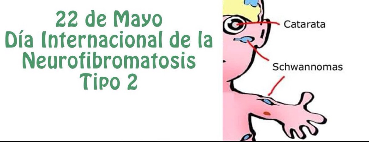 RarasNoInvisibles (@noinvisibles) on Twitter photo Hoy demos mas visibilidad a la #NFT2 
Día Internacional de la Neurofibromatosis Tipo 2 y la #Schwannomatosis
Info en <a href="/asociacion_anf/">#AANF</a>
#DespejalaNF #AANF #NF2 #neurofibromatosis #nf2 
Se caracteriza por afectaciones en la piel y visuales.
La Investigación es la esperanza 💪 Hoy demos mas visibilidad a la #NFT2 
Día Internacional de la Neurofibromatosis Tipo 2 y la #Schwannomatosis
Info en <a href="/asociacion_anf/">#AANF</a>
#DespejalaNF #AANF #NF2 #neurofibromatosis #nf2 
Se caracteriza por afectaciones en la piel y visuales.
La Investigación es la esperanza 💪