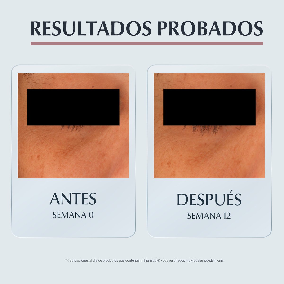 EucerinES's tweet photo. ¡NOVEDAD #Eucerin!
👉 Ampliamos nuestra gama #AntiPigment con un contorno de ojos y #antiojeras que realmente funciona.
💜 El nuevo Anti-Pigment Contorno de Ojos Despigmentante y Anti-ojeras.
👉 https://t.co/GsUM9dfol3 https://t.co/W4ZnNSo3aQ