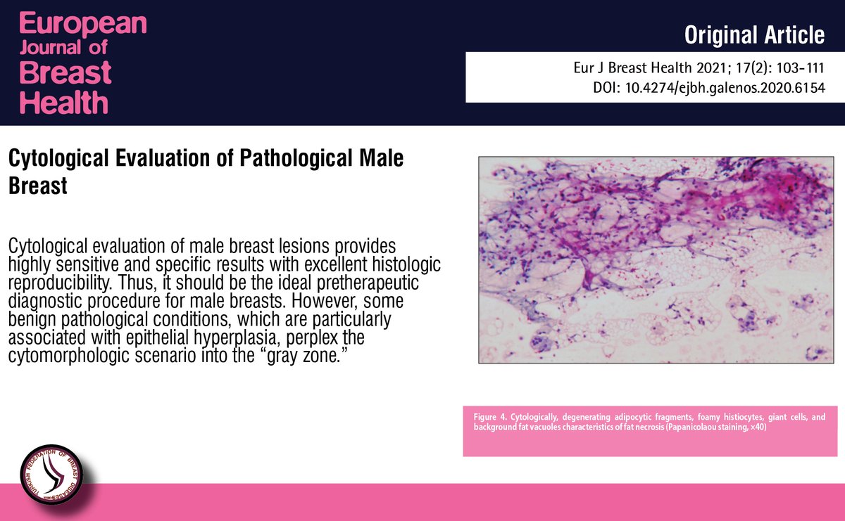 Cytological Evaluation of Pathological Male Breast Lesions

You can see the free full text of the research by Krishnendu Mondal et al

Link : cms.galenos.com.tr/Uploads/Articl…

#Breastcarcinoma #fineneedle #aspiration #cytology #grayzone #gynecomastia #malebreast