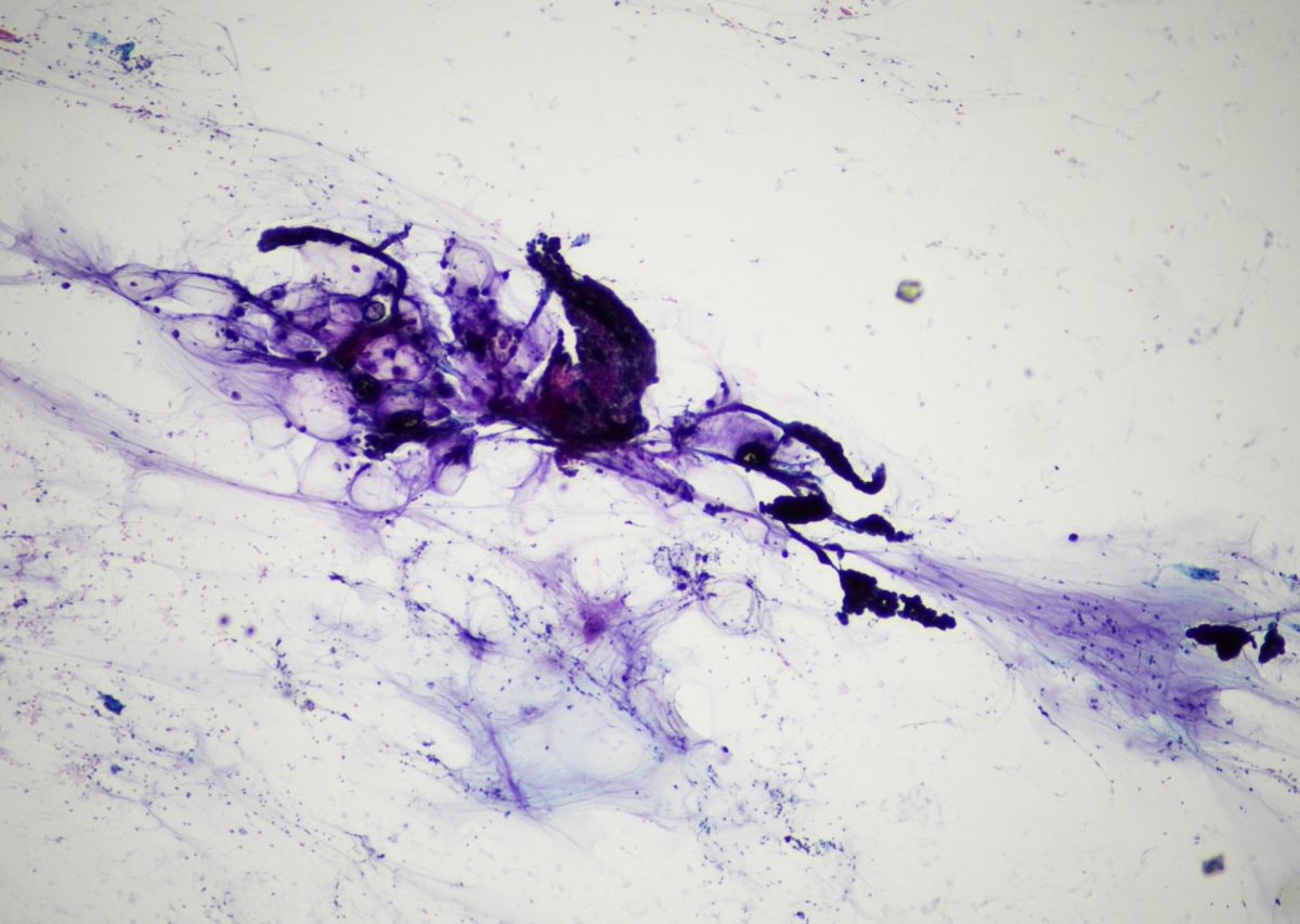 9Nr1KCDfUhG9RYO's tweet photo. M,36.Urinary bladder mass ~ 10 cm. Tumor arises from the apex.Voided urine.Conventional smears, MGG,PAP. Cell block is in progress. What IHCs should we use?
@ElmiraKomissar6 @elsa_borisova @pepeheffernan @IvanaKholova @eva_wojcik @DianaEstherossi @AshishC97225686 @LukasBubendorf https://t.co/tF1SX1EhYd