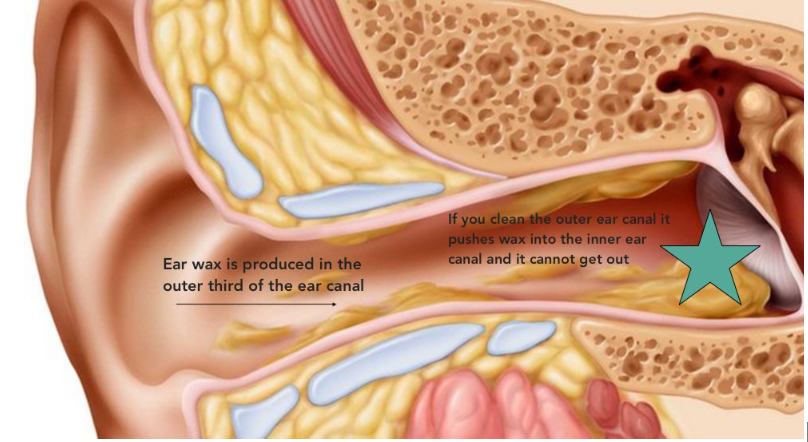 We see more men than women for ear wax removal, but wax is produced equally by everyone. 
So why do we see more men than women?
It could be because women, who take the contraceptive pill produce much less earwax! Or it could be that men use earbuds or cotton buds to clean their e