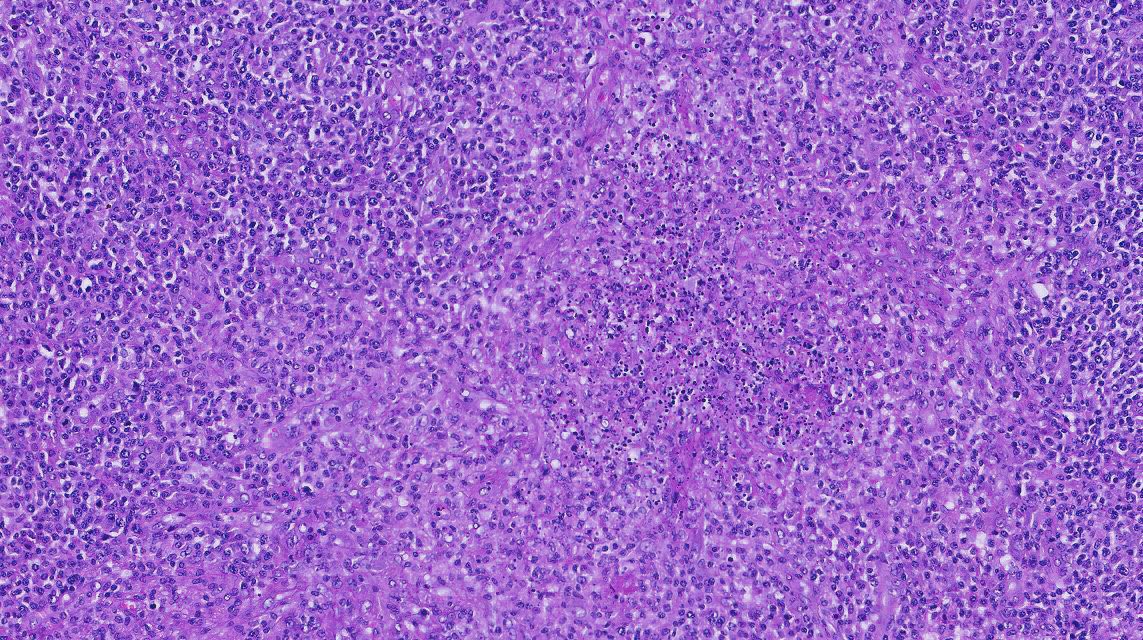 Tiger_heme's tweet photo. Neck lymph node 58 yo male@with sudden fever and rash. Note the foci of necrosis and apoptotic debris! Your differential? Stains you would order? https://t.co/LbsViIXM1v