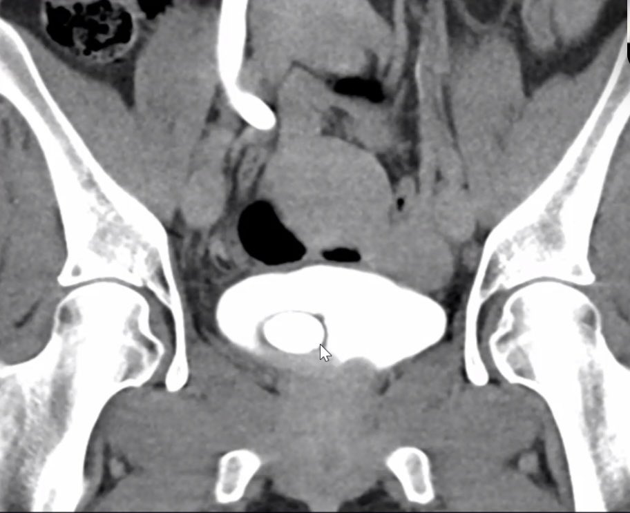 MayoUrology's tweet photo. Today’s #MondayMorningConference question: 30 yoF presents with R sided flank pain, UA >20 RBC, -nit, -LE. WBC 12, Cr 1.2. CT AP shows the following. See thread for question. https://t.co/af22tzh7Sd