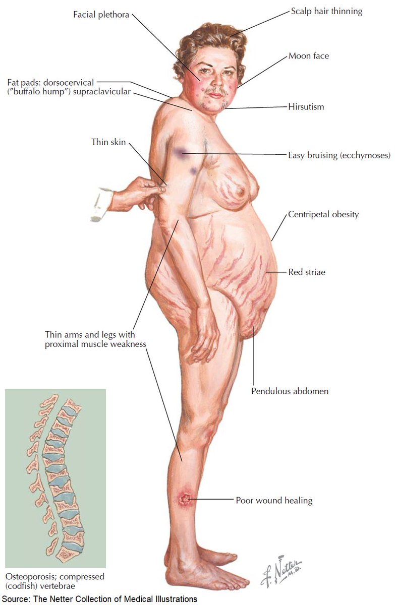 ManualOMedicine's tweet photo. Cushing Syndrome - Clinical Findings

#foamed #medtwitter https://t.co/m8A5b2ZiuK