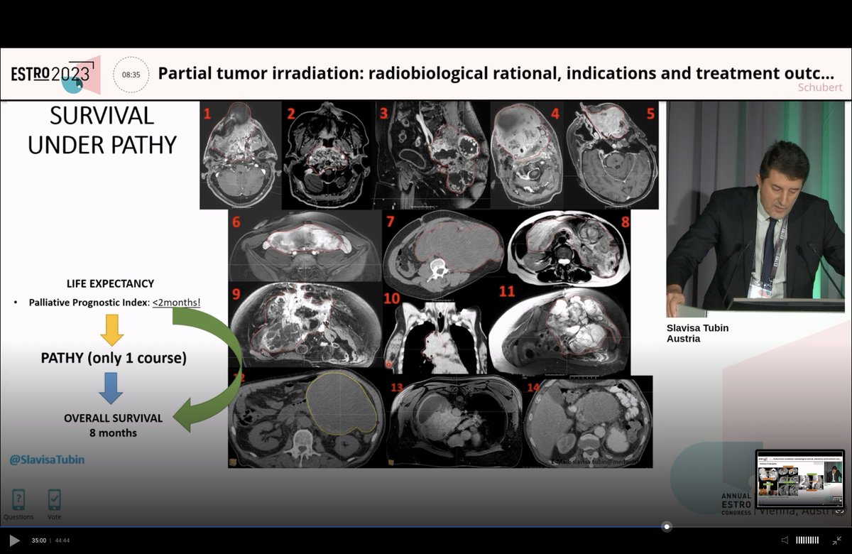 Slavisa Tubin at #ESTRO23 on a novel unconventional partial tumor irradiation for unresectable/recurrent/bulky tumors unsuitable for conventional RT. This immunomodulatory approach improves therapeutic ratio adding to radiation an immune-mediated tumor-cell killing component.