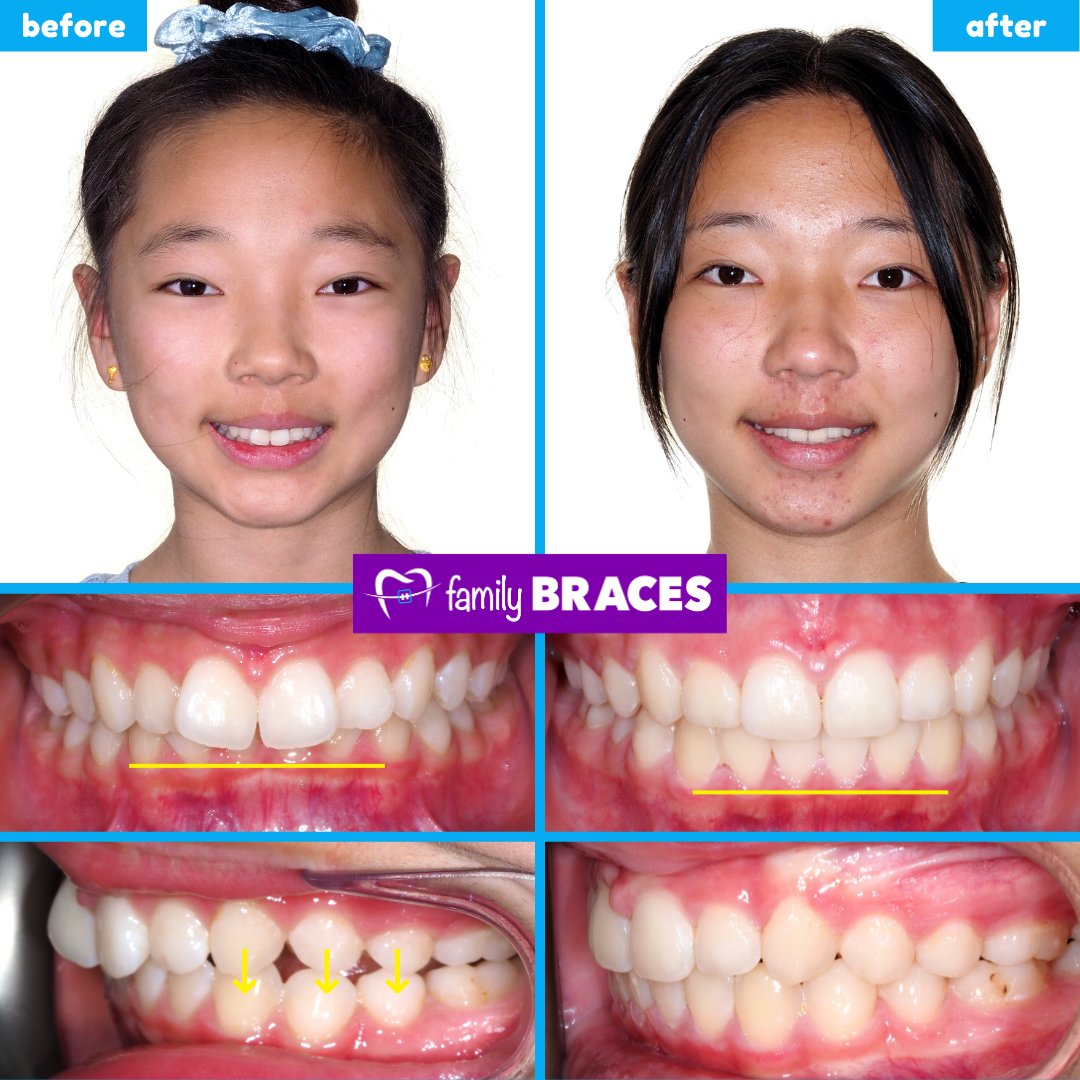 family_braces's tweet photo. 😢 Problem: Misaligned Deep Bite and Upper/Lower Crowding
👩🏻‍⚕️ Solution: Bite Corrector then Invisalign
📆 Treatment Length: 14 months
😀 Results: a Monumental Transformation🗽

🤷🏻‍♀️ We thought it would be fitting to show off Victoria's new smile today 😉

#VictoriaDay #Invisalign https://t.co/PPoDLIPxF2