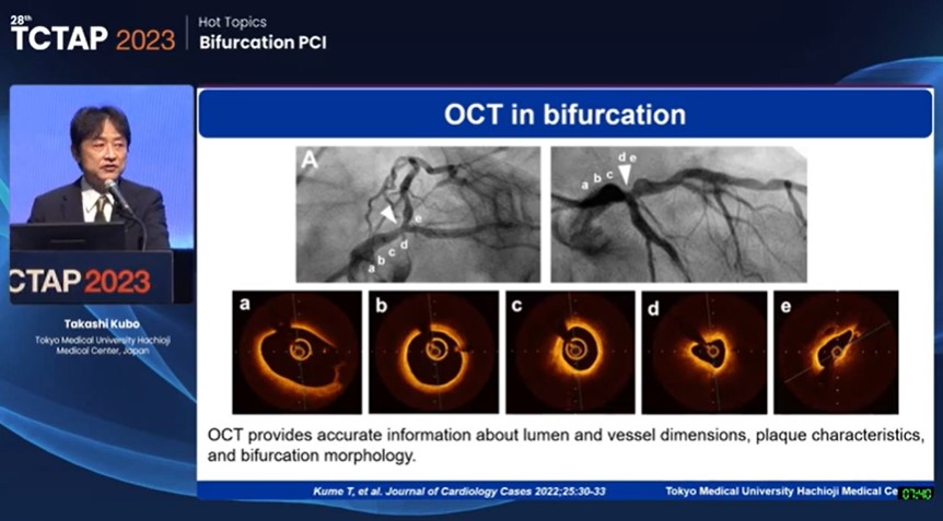 Zill_cardio's tweet image. #TCTAP2023

#BifurcationPCI

❤️‍🔥#ICYMI: A Complete Guide to OCT-Guidance for Bifurcation PCI in a Step-by-Step Approach👇

#ImageFirst @summitmd_cvrf #On_Demand #1/4

🔗👉summit-tctap.com/2023/video_vie…