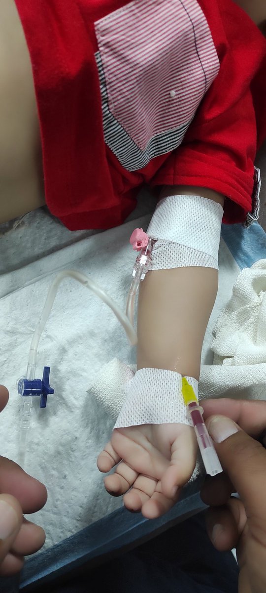 Trigger warning
Reason # 1103 why i love Ultrasound guided vascular cannulation/access.
P.S: this young lad with a 20 G IV cannula and a radial art line is 2 years old