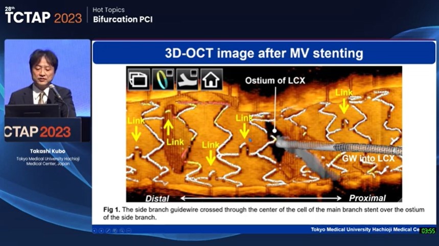 Zill_cardio's tweet image. #TCTAP2023 #BifurcationPCI #OCT_Guidance
@summitmd_cvrf
#3/4    
#STEP 2⃣: GuideWire Recrossing

OCT facilitates GW Recross by evaluation of :

✅Stent struts covering SB ostium
✅Stent link location
✅GW recrossing site