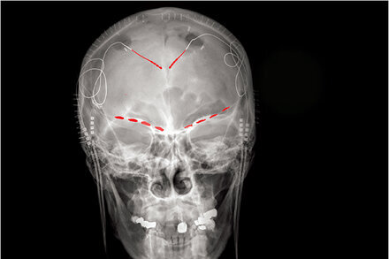 "Scientists Find Brain Signals of Chronic Pain" via NYT ift.tt/gFoU3qh