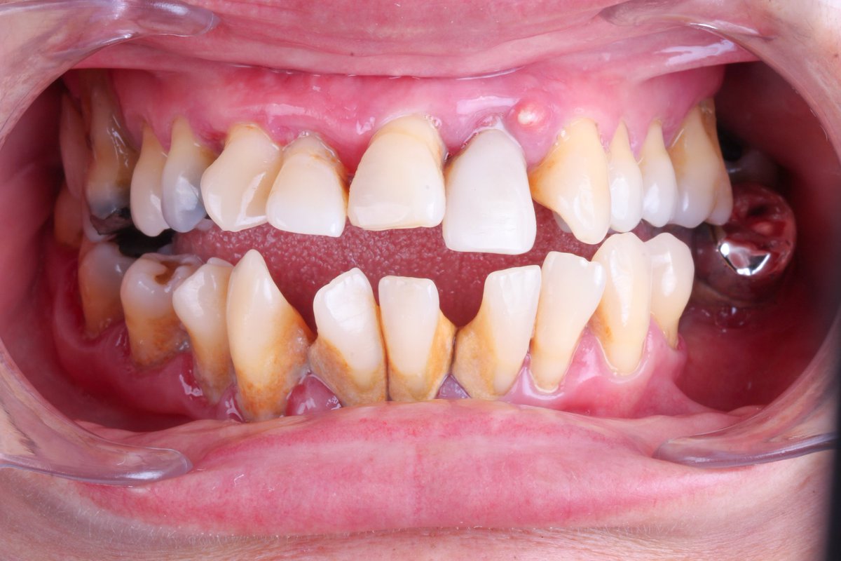 Les cuento algo real "A pesar de que se conoce el término "periodontitis" la mayoría de los cirujanos dentistas no saben diagnosticarla #fact #periodontitis #gingivitis #verdadero