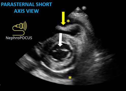 NephroPOCUS tweet media