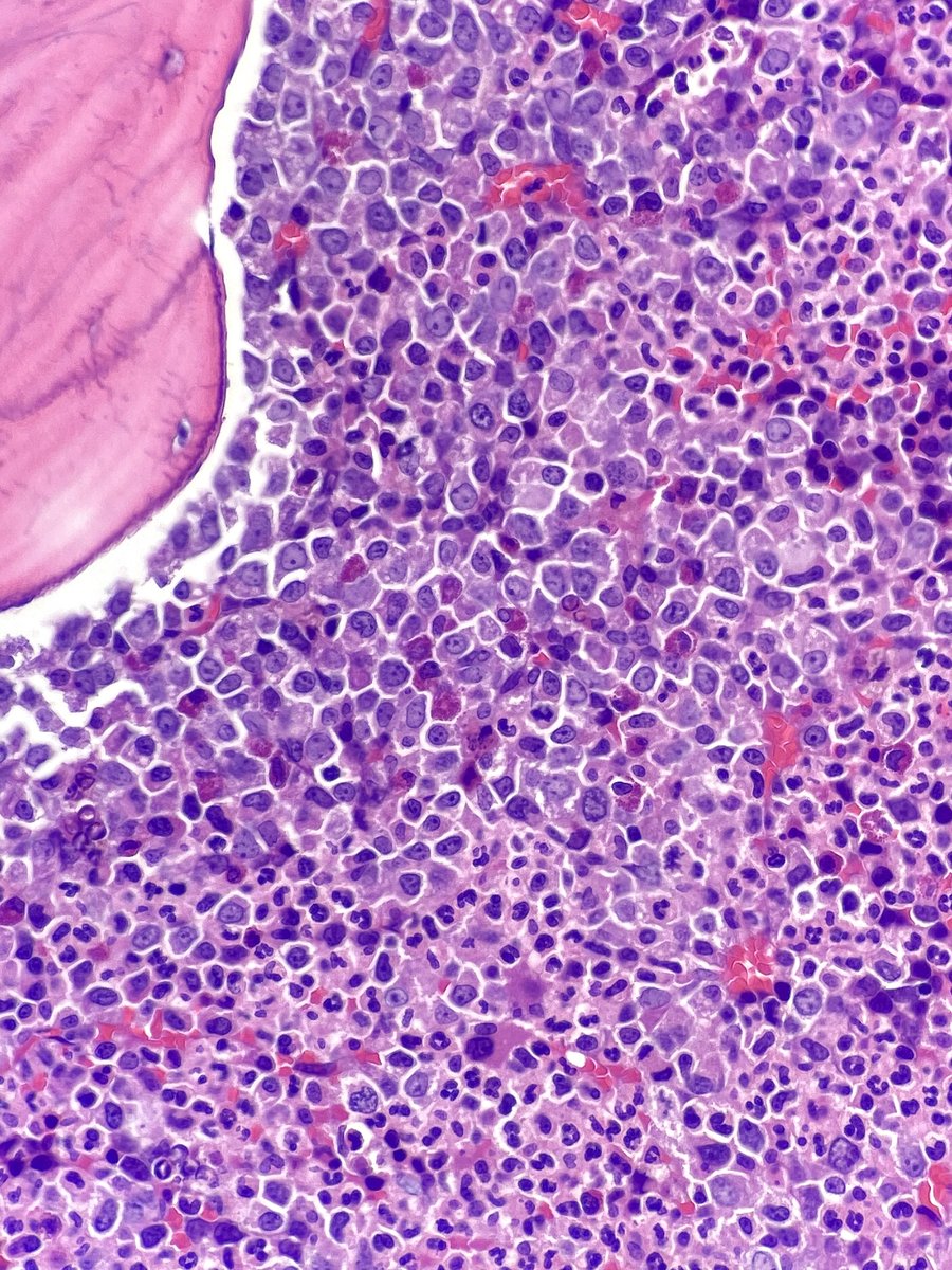 Bone marrow biopsy of chronic myeloid leukemia (CML) demonstrating increased layers of immature granulocytes around trabecular bone. BCR-ABL p210 isoform: most common p190: a/w⬆️monocytes p230: a/w prominent neutrophilic maturation, thrombocytosis