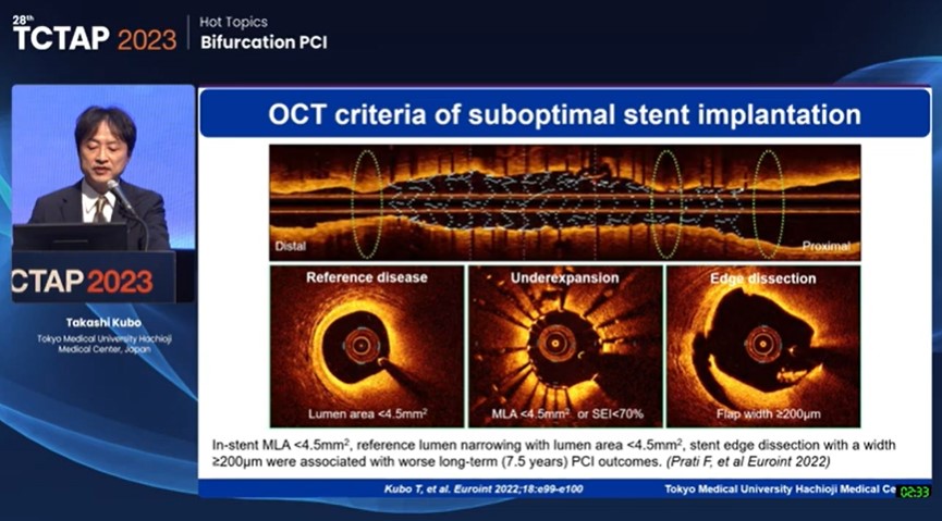 Zill_cardio's tweet image. #TCTAP2023 #BifurcationPCI #OCT_Guidance
@summitmd_cvrf

#4/4
#STEP 3⃣: Optimization OCT after KBI helps in the assessment of :

✅Stent deformation
✅Stent under expansion
✅Stent edge dissection

In-stent MLA &amp;lt;4.5 mm &amp;amp; edge dissection of &amp;gt;200um ➡️poor longterm outcome