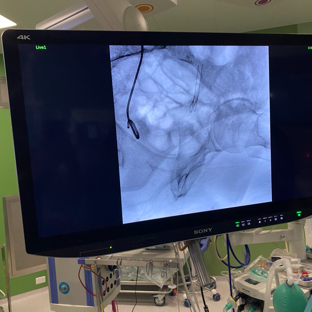 CookMedical's tweet photo. Dr. Alberto Parmigiani in Italy just performed his first procedure with a Cook metallic ureteral stent in a patient that had hydronephrosis due to lymph node compression from metastatic renal cell carcinoma. No nephrostomy needed! Positioning only took 15 minutes. https://t.co/FwZhENqHa0