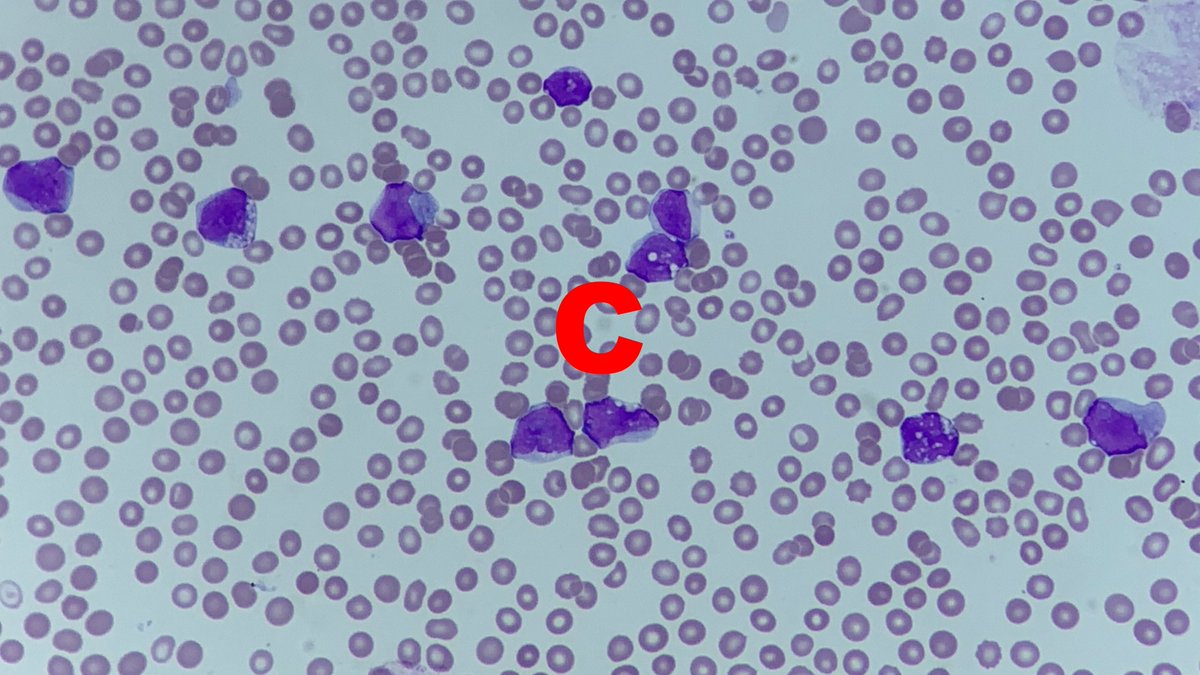 #MorphologyMonday

Thrombocytopaenia, or a low platelet count can be caused by a multitude of reasons. When you see a lack of platelets on the film, what goes through your mind? Here are 3 images with decreased platelets, can you guess what's going on in each?

#OnlyCells