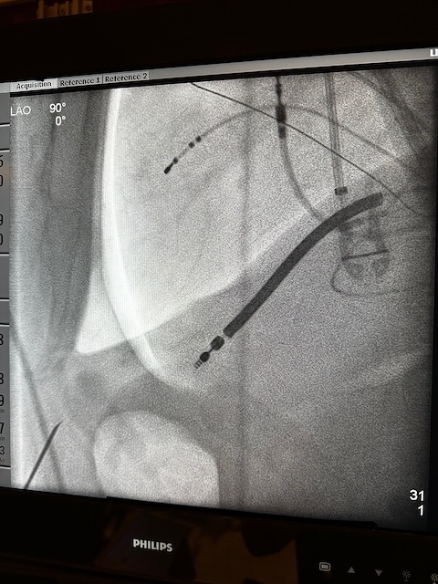 Pericardial access for epicardial VT ablation following CO2 insufflation of the pericardial space. Super slick. @NishantVermaMD @GrahamLohrmann @NMCardioVasc @DrBradleyKnight