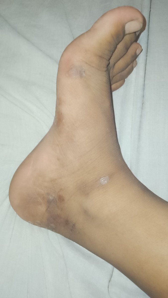 Olá, primeiramente gostaria de dizer que eu não estaria fazendo isso se eu realmente não precisasse, ninguém gosta de expor off né? Mas eu queria pedir ajuda de vcs. Eu preciso realizar um procedimento no dermatologista urgentemente, o SUS tem um prazo enorme e a consulta