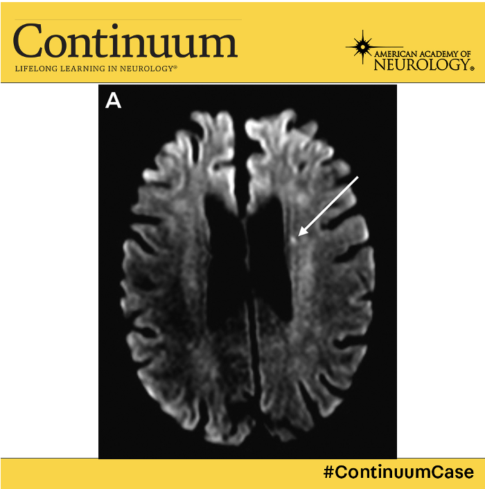 1/ A 75 yo M w/ HTN and AF presents with 2 days of dysarthria and a R facial droop. He reports compliance with his DOAC (Rivaroxaban 20mg QD) MRI demonstrates a punctate infarct in the corona radiata. MRA is clean. 🤔🤔🤔Do you consider this a DOAC failure? A #ContinuumCase