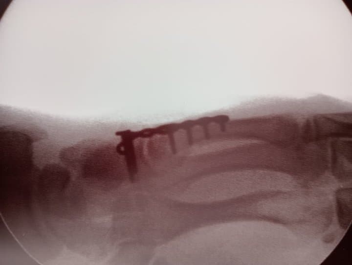 I didn't realise there was a tweet about me. Broken hand and ribs. Thanks <a href="/QldAmbulance/">Queensland Ambulance</a>