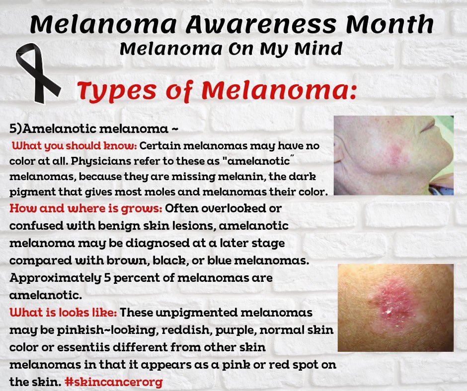 Melanomaonmymin's tweet photo. 🖤Melanoma Awareness Month🖤
Types of Melanoma:
5) Amelanotic melanoma -
What you should know: (Information in graphic) #melanoma #awareness #skincancerorg #melanomaonmymind #skin #cancer #prevention #skinchecks #amelanoticmelanoma #amelanotic #skincancerfoundation #skincare https://t.co/8I5NeYj6eV