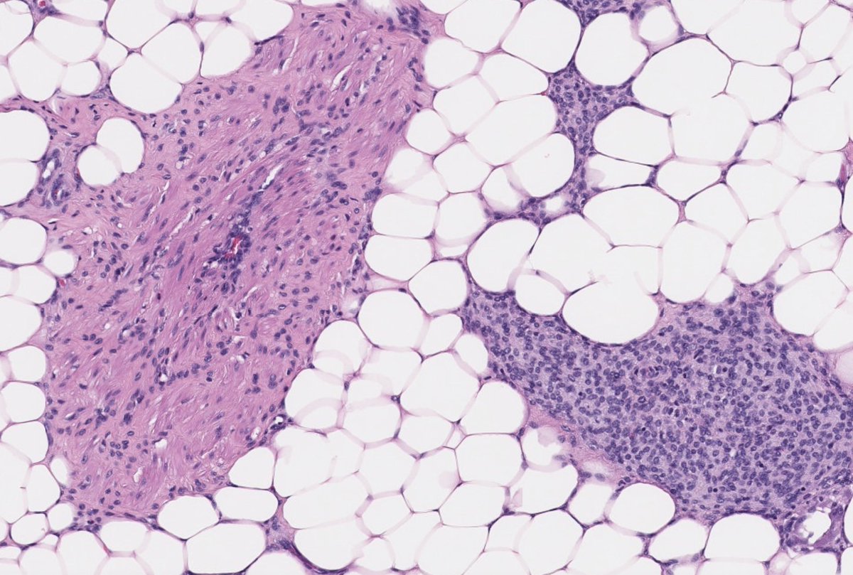 13 month old male presents with a painless, ill-defined thigh mass. Diagnosis? What molecular finding is associated with this entity? Answer in the comments! #PathTwitter #pedipath #meded #pediatrics