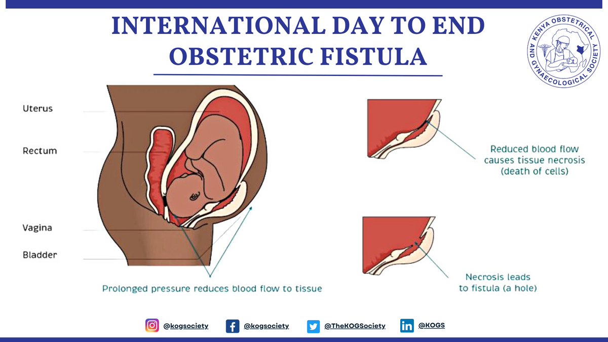 Today, we commemorate the International Day to End Obstetric Fistula, shedding light on this preventable and treatable condition affecting countless women around the world. Let's raise awareness and work together towards its eradication. #EndObstetricFistula #KOGSNawe #EndFistula