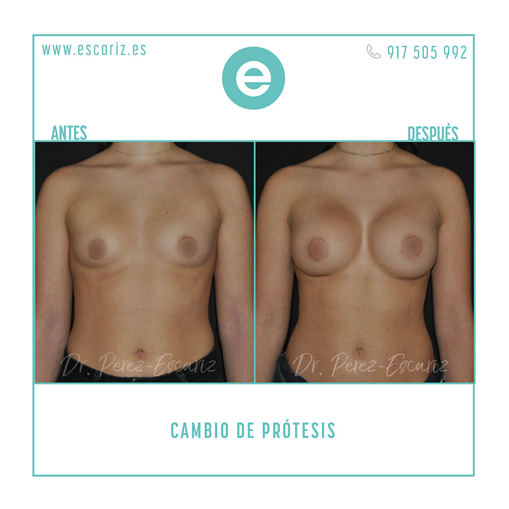 DrPerezEscariz's tweet photo. Para leer sobre la asimetría mamaria da clic aquí https://t.co/lKHSTTtKF5
#cirugíaplástica #cirugíaestética #DrEscariz #plasticsurgery #plasticsurgeon #cirujanoplástico #Madrid #bestplasticsurgery #belleza #beauty #ClínicalaLuz #secpre #asimetriamamaria https://t.co/TZoyKlOsuu