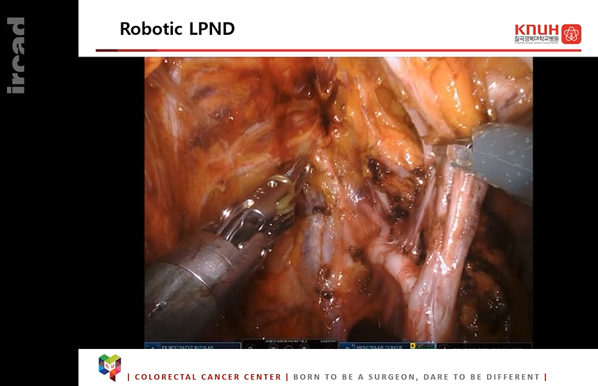 🚨NEW VIDEO ALERT: Colorectal surgery
🔗 bit.ly/3oyecFH
'Standardized robotic lateral pelvic lymph node dissection (LPND) - based on anatomy'

#websurg #ircad #surgery #minimallyinvasivesurgery #colorectalsurgery