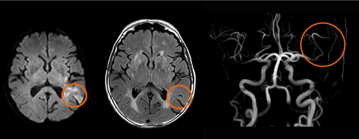 Take a look at #stroke across the whole pathway: from stroke prevention to acute stroke imaging, including fast imaging and perfusion evaluation.
Don't miss this collection of articles at …ng.webassets.siemens-healthineers.com/aac46971152371…

#magnetomworld #MRI #SiemensHealthineers #ESOC23