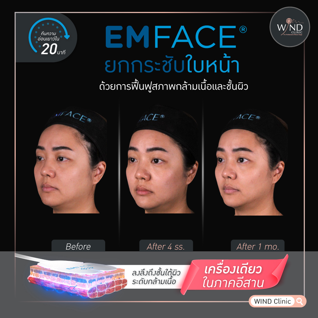 windclinic's tweet photo. ส่องนวัตกรรมใหม่มาแรง EMFACE
ยกกระชับหน้าแบบไม่เจ็บ ไม่ใช้เข็ม ใช้หน้าต่อได้ทันที
ทำเสร็จเห็นผลลัพธ์อ่อนเยาว์ภายใน 20 นาที

EMFACE  2 เทคโนโลยี ใน 1 โปรแกรม พลังงานคลื่น RF และ HIFES
ช่วยกระตุ้นกล้ามเนื้อ พร้อมกระชับผิวในคราวเดียว

#ปรับรูปหน้า #มืออาชีพตัวจริง #EMFACE #เก๋ไก๋ https://t.co/qTzPie57jo