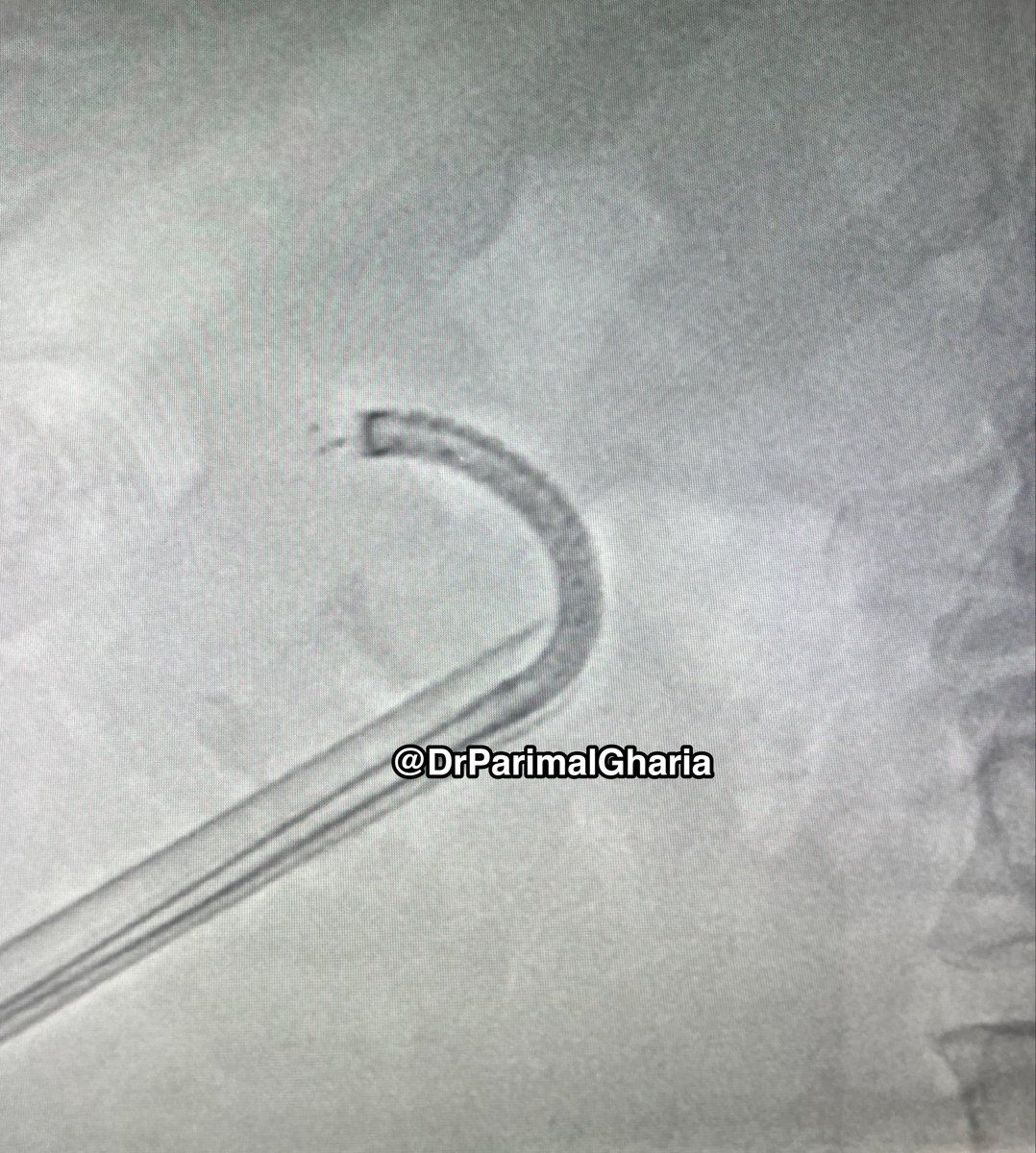 DrParimalGharia's tweet photo. Change the way we do PCNL.
13.5 Fr Flexible CystoNephroscope did the trick.
All calyces were accessed .
Upper & Middle calyces stone fragmented with Holmium.
All stones retrieved. https://t.co/sZXUz1jo8G
