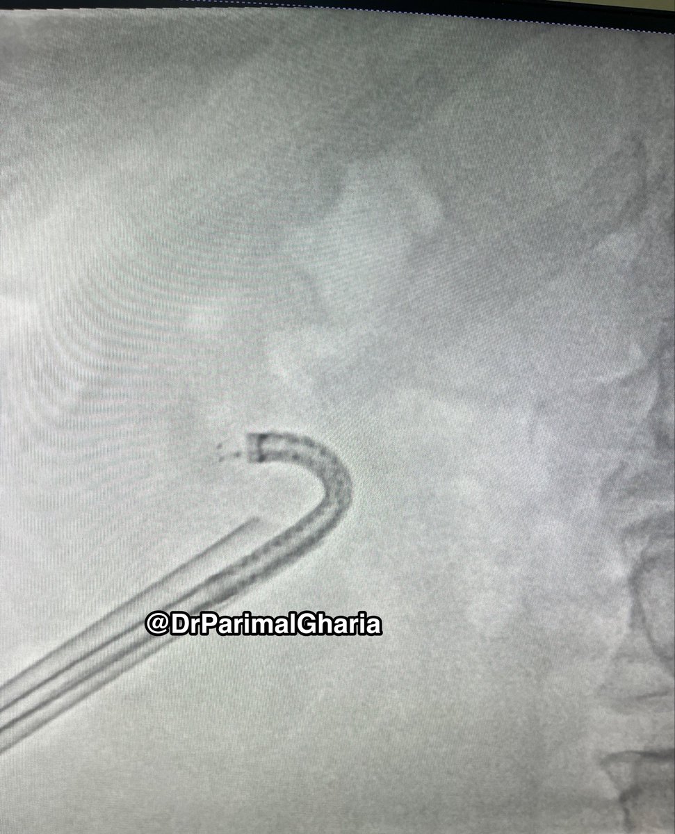 DrParimalGharia's tweet photo. Toughest & Parallel Calyces were also accessed .
Complete clearance Fromm Single Tract ensured.
#TubelessPCNL.
@GoumasUrologia @EndoLuminalEndo @StefaniaFerret @Mohamedendourol @mohamed92902484 @AnilElhence @Shresthanyl @drnanjappa https://t.co/AW4rvilXgx