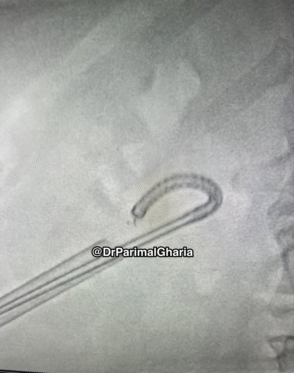 DrParimalGharia's tweet photo. Toughest & Parallel Calyces were also accessed .
Complete clearance Fromm Single Tract ensured.
#TubelessPCNL.
@GoumasUrologia @EndoLuminalEndo @StefaniaFerret @Mohamedendourol @mohamed92902484 @AnilElhence @Shresthanyl @drnanjappa https://t.co/AW4rvilXgx