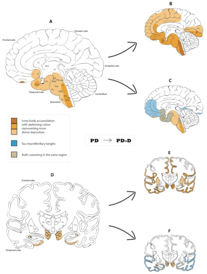 Pathophysiology underpinning the development of dementia in Parkinson's disease. 

 Credits: A. Russell, A.Drozdova, M. Thomas, W. Wang  

#neuroscience