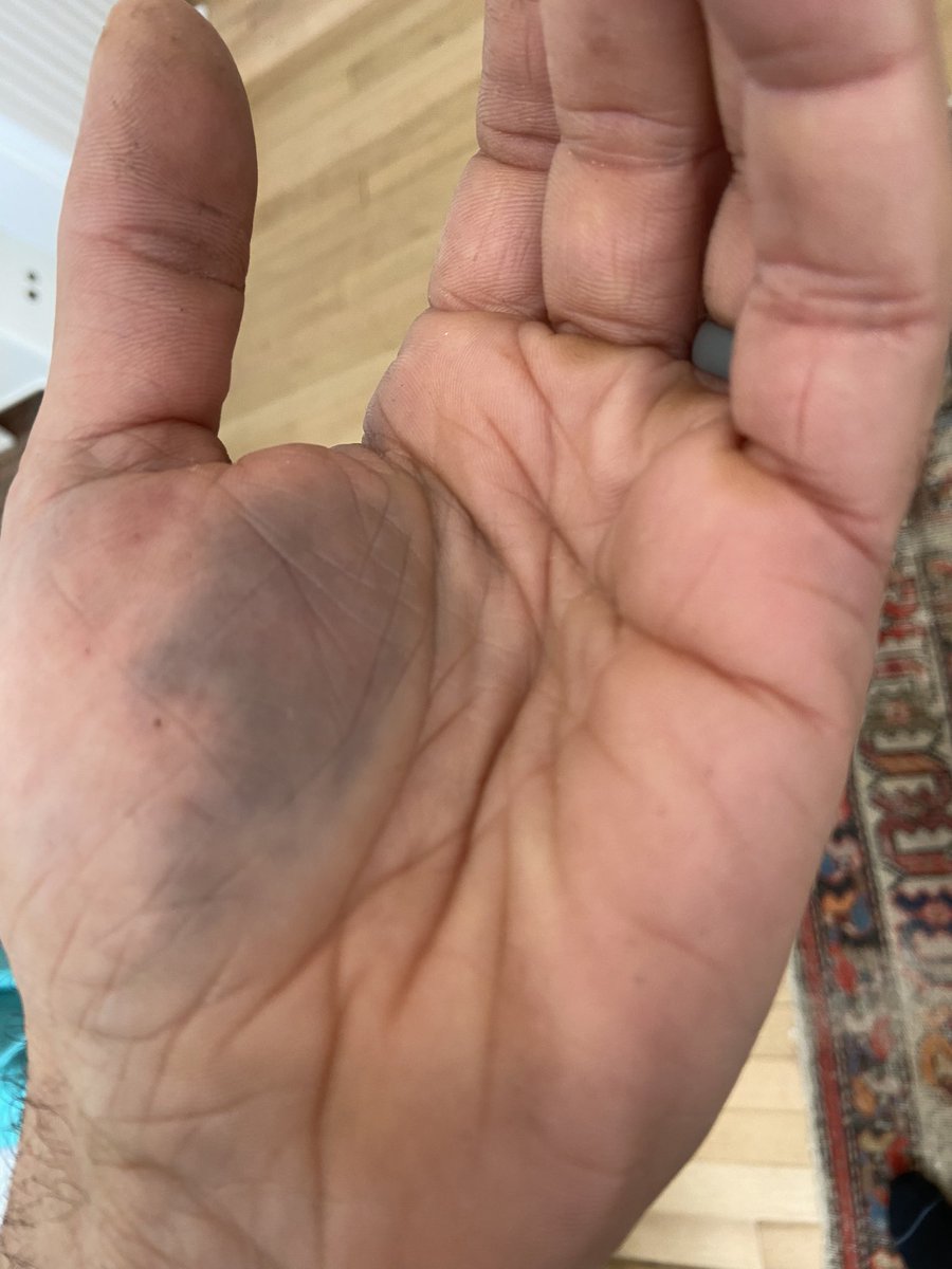 mark_odlum's tweet image. I feel like my hand modeling days may be over.  Thumbs, apparently don’t like bending in the wrong direction.