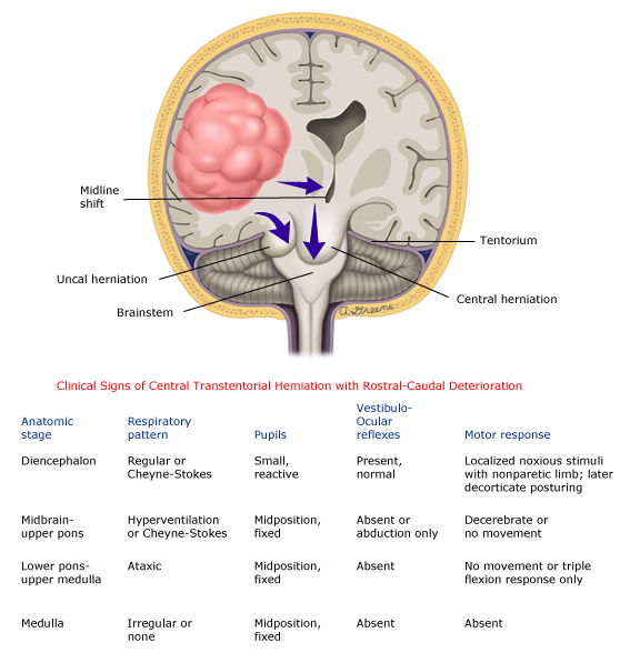 Progressive signs of brainstem injury from herniation.  

Source: Plum F, Posner JB, FA Davis  

#MedTwitter
