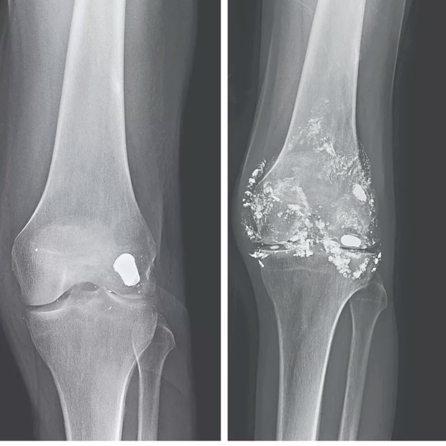 Oren Gottfried, MD on Twitter "Patient with abdominal pain, fatigue