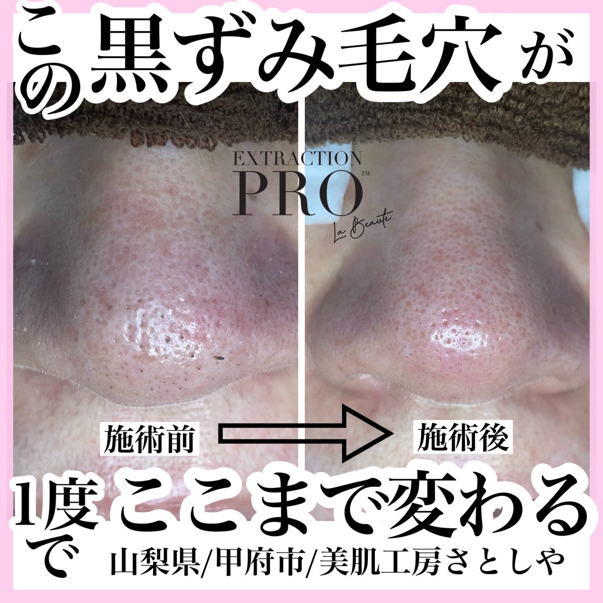 sat0sh1ya's tweet photo. 昨日美容マニアのインフルエンサーさんが絶賛ツイートしてバズっている【毛穴エクストラクションプロ】の施術は当店でも受けられます！昨年から導入し認定サロンとして沢山のお客様にリピートしていただいてる人気エステメニューとなっております！山梨県で毛穴にお悩みの方は是非1度ご体験下さい☺️ https://t.co/19XdNIhVdO
