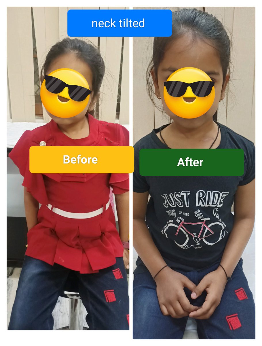 vivekshrivasta8's tweet photo. Simple surgery for complex problem of neck bending #torticollis #neckbendinG #CMT https://t.co/O8Ttpi2Emo