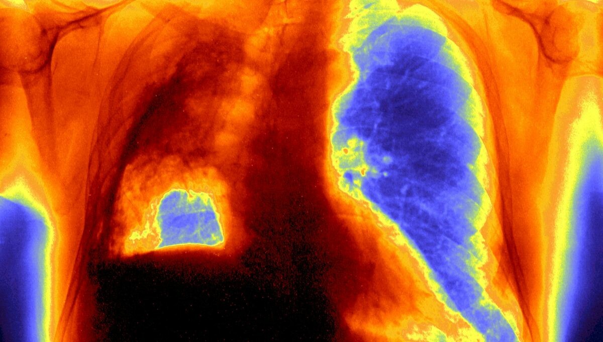 Cancer du poumon : un traitement réduit de moitié le risque de décès de la forme la plus répandue

Un espoir pour des millions de patients ➡️ l.franceinter.fr/8cz