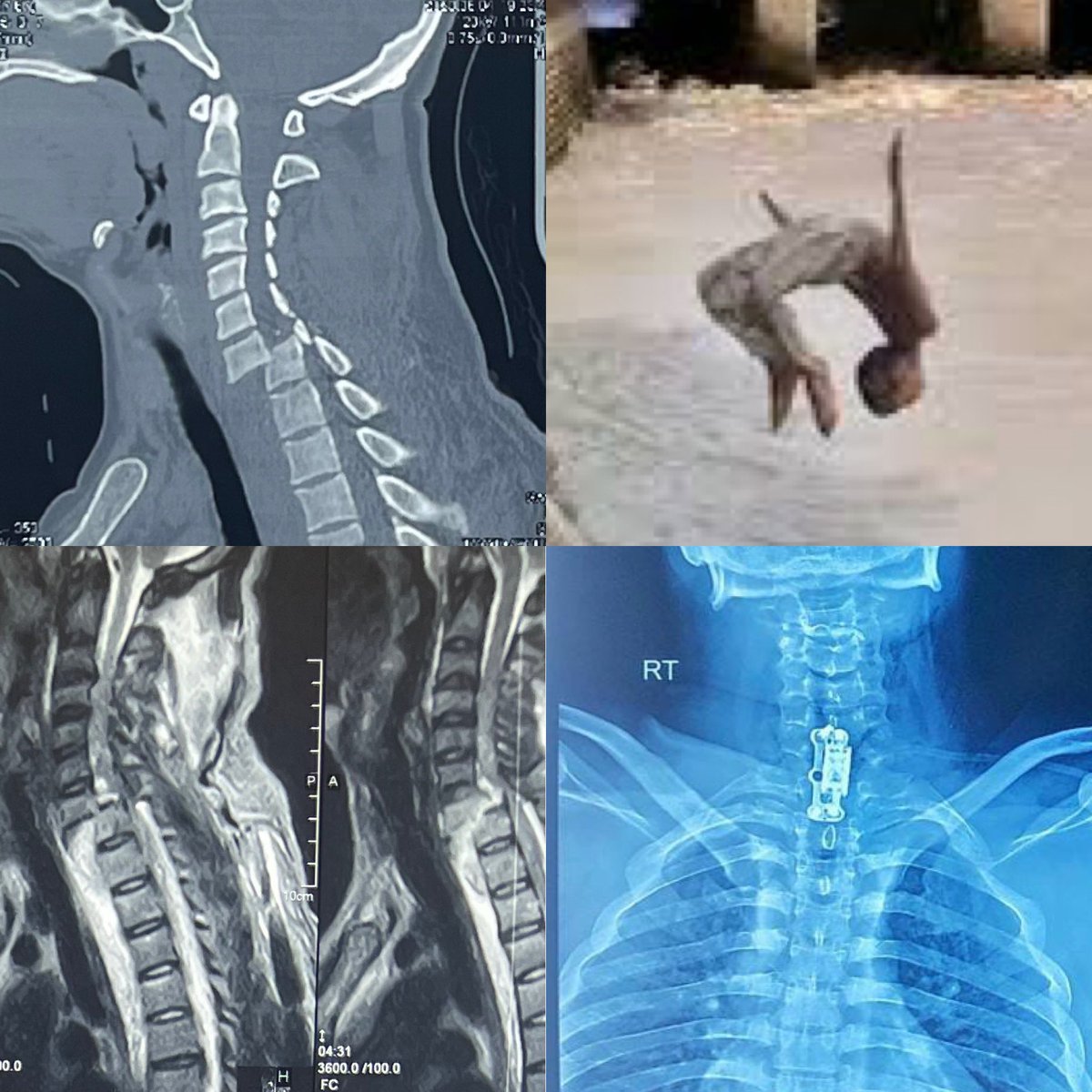 Dr Latif Khan FCPSOrth on Twitter "Spinal cord injuries result after diving into shallow water