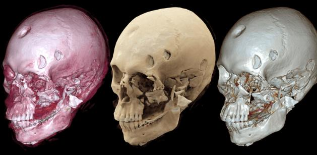 The VIFM short courses, an Introduction to Human Osteology (26th-29th June) and Analysis and Interpretation of Skeletal Trauma (4th-7thJuly), may be for you! Only a few places are still available for each course, so register soon at vifm.org/teaching-and-r…