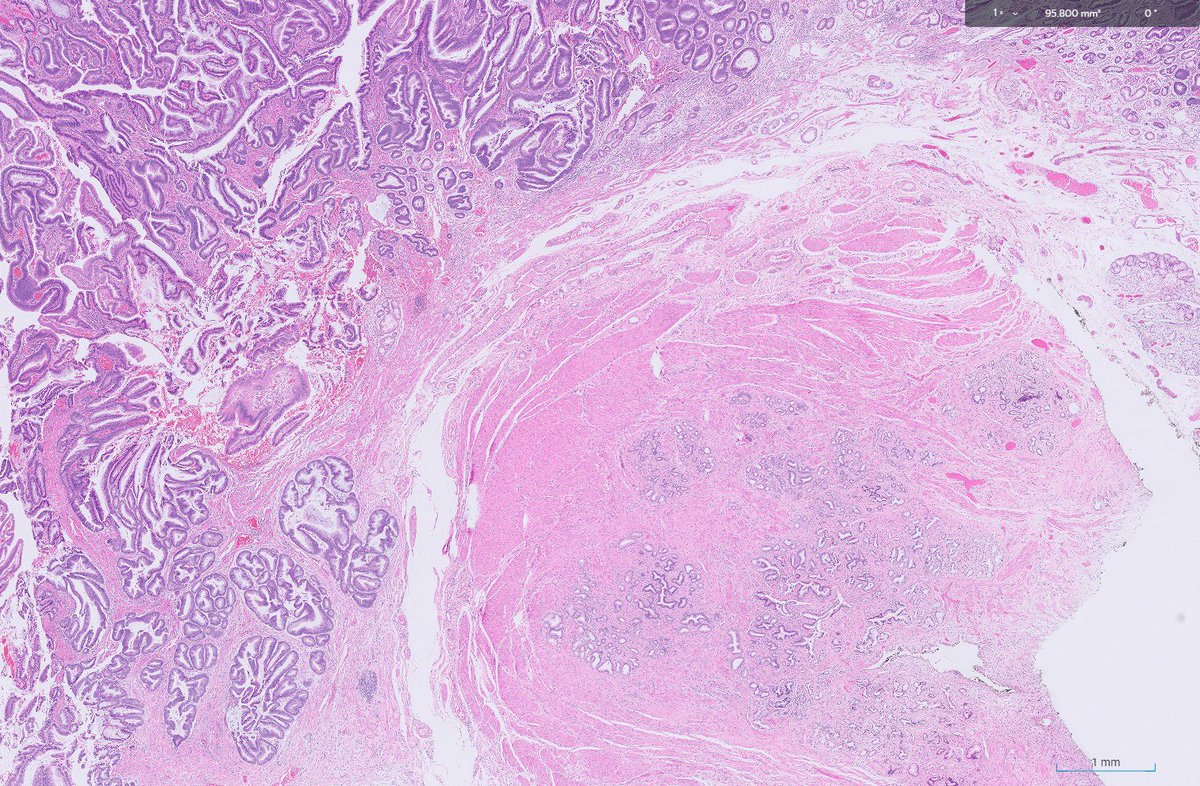 RawiaMo57385655's tweet photo. Robotic ampullectomy ..
#GItpath #pathtwitter #pathologyfamily https://t.co/CtFg3QxxSi