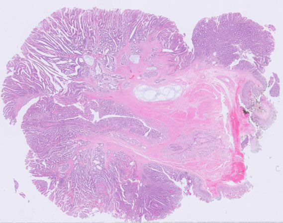 RawiaMo57385655's tweet photo. Robotic ampullectomy ..
#GItpath #pathtwitter #pathologyfamily https://t.co/CtFg3QxxSi