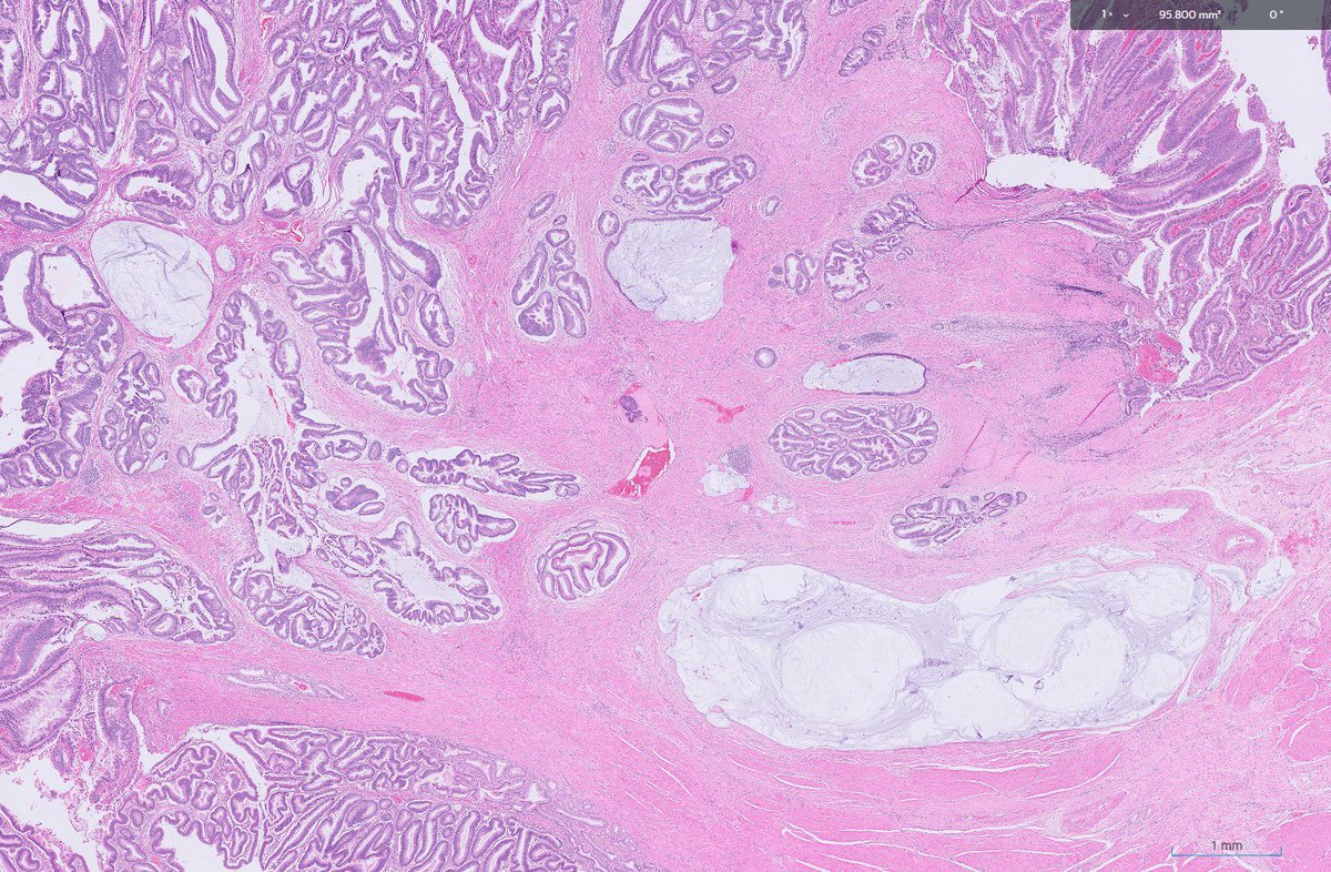 RawiaMo57385655's tweet photo. Robotic ampullectomy ..
#GItpath #pathtwitter #pathologyfamily https://t.co/CtFg3QxxSi